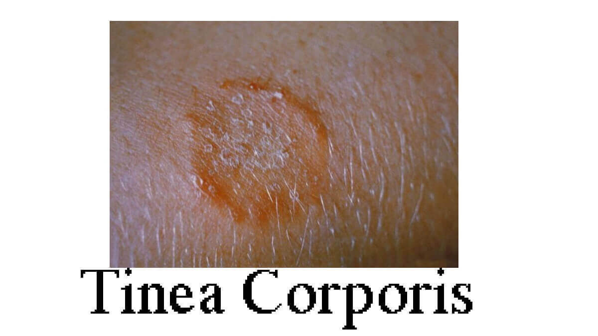 Tinea Corporis Definition 10 Causes Symptoms Diagnosis Tinea Corporis Definition 10 Causes Symptoms Diagnosis