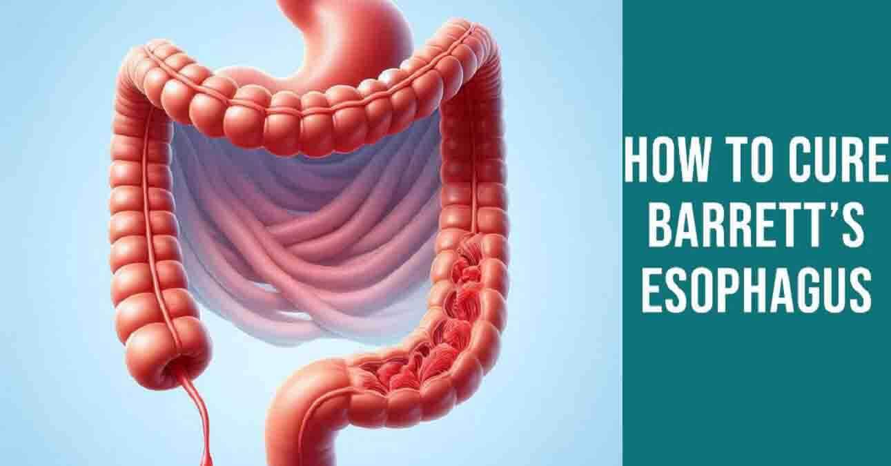 How To Cure Barrett’s Esophagus Naturally Discover Healing Methods
