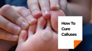 5 Powerful Ways How To Cure Calluses