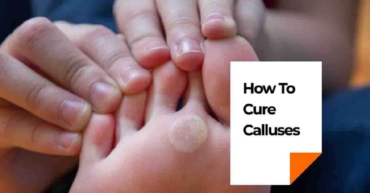 How To Cure Calluses