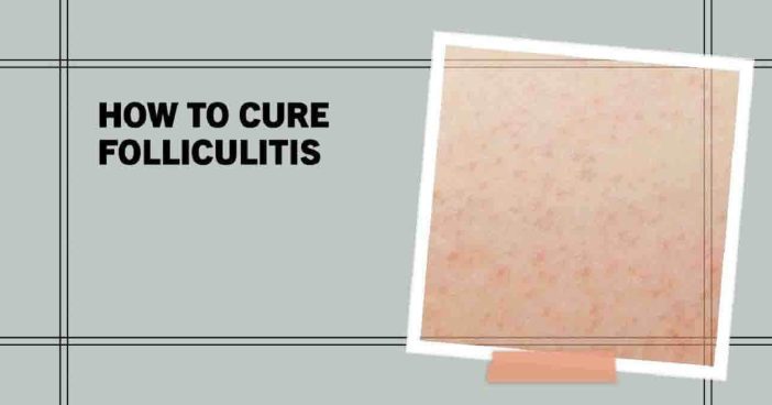 How To Cure Folliculitis