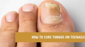 10 Proven Ways How To Cure Fungus On Toenails