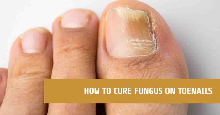 How To Cure Fungus On Toenails