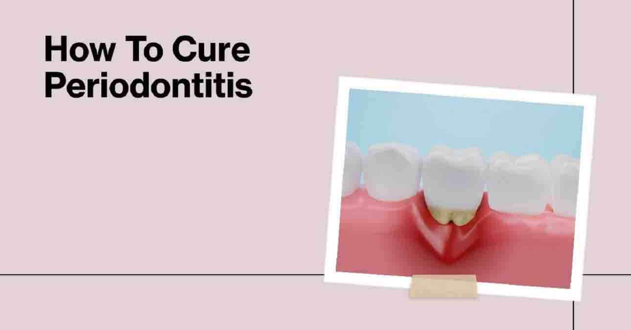 How To Cure Periodontitis
