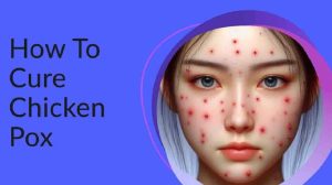 How To Cure Chicken Pox