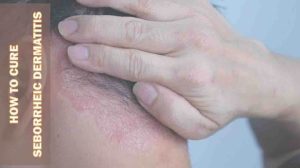 How to Cure Seborrheic Dermatitis