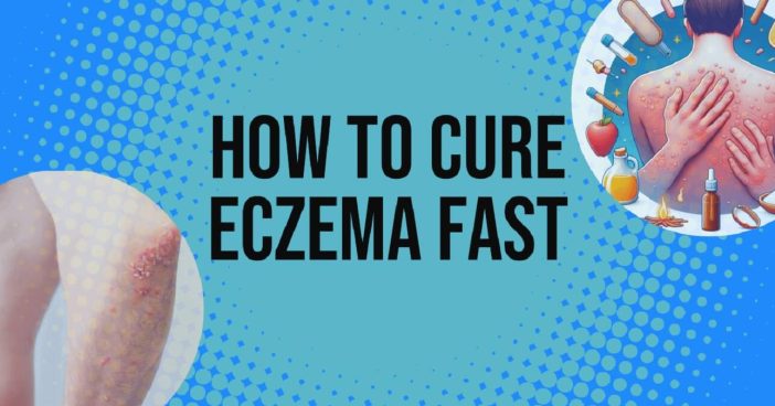How To Cure Eczema Fast