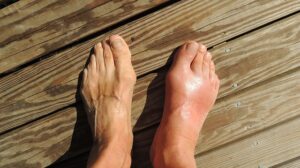How To Cure Gout Naturally
