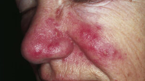 How To Cure Rosacea