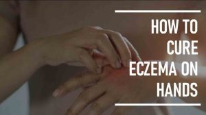 How To Cure Eczema On Hands