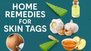 Home Remedies for Skin Tags