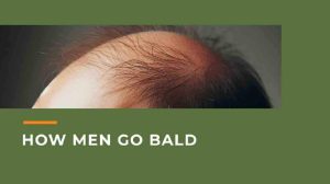How Men Go Bald