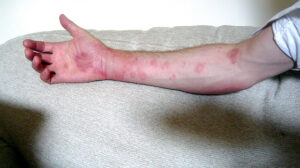 Chronic idiopathic urticaria: The causes, symptoms, treatment, and how to care of it