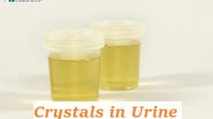 Crystals in Urine