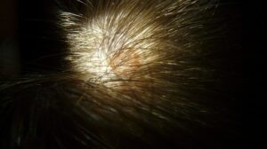 Dandruff Vs Dry Scalp: The Causes and How To Resolve It