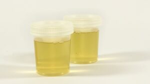 6 Causes of Mucus in Urine