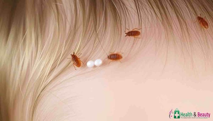 What Does Head Lice Look Like