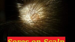 Sores on Scalp: The Causes, and How Soothe and Get Rid of It
