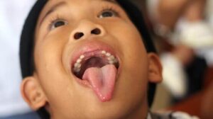 White Spot on Tongue: Causes and treatment