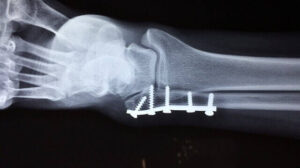 Fracture Ankle