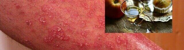 Apple Cider Vinegar For Psoriasis