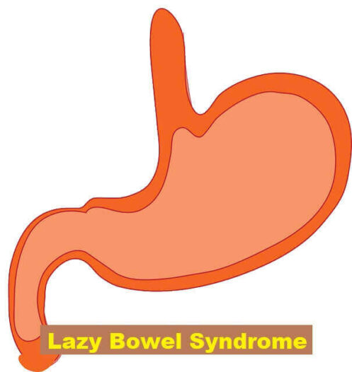 Lazy Bowel Syndrome