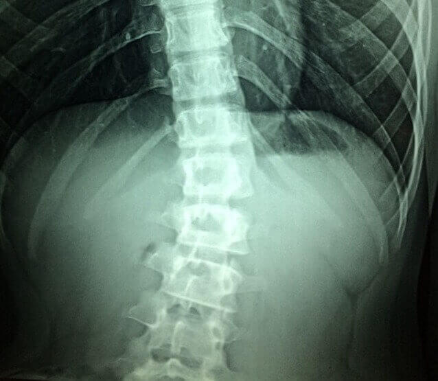Acute Flaccid Myelitis: 8 Symptoms, Causes, and Diagnosis