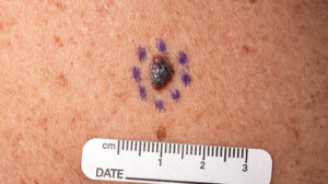 Skin Cancer Melanoma: Statistics, 4 Types, Causes, and Symptoms