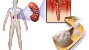 Cancer Of The Kidney: 7 Causes, Symptoms, and Diagnosis