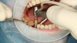 Dental Implant: Definition, 7 Advantages, and Processes