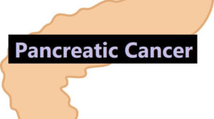 Pancreatic Cancer: Definition, 5 Causes – Risk Factors, and Diagnosis