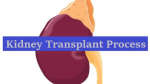 Kidney Transplant Process