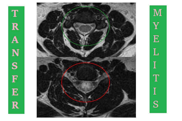 Transverse Myelitis