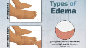 What Is Edema: 6 Types, Symptoms, and Causes