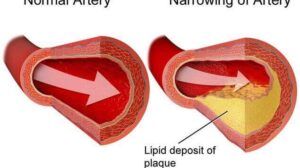Atherosclerotic Cardiovascular Disease: 4 Symptoms, Causes, and When To See A Doctor