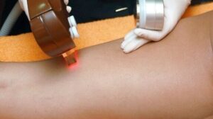 Laser Hair Removal: 4 Preparations Tips, Process, and Pros Cons