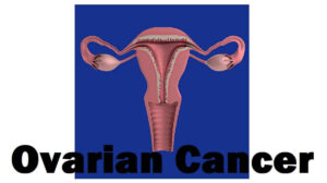 Ovarian Cancer: 3 Types, Causes, Risk Factors, Stages, Complications, and When To See a Doctor