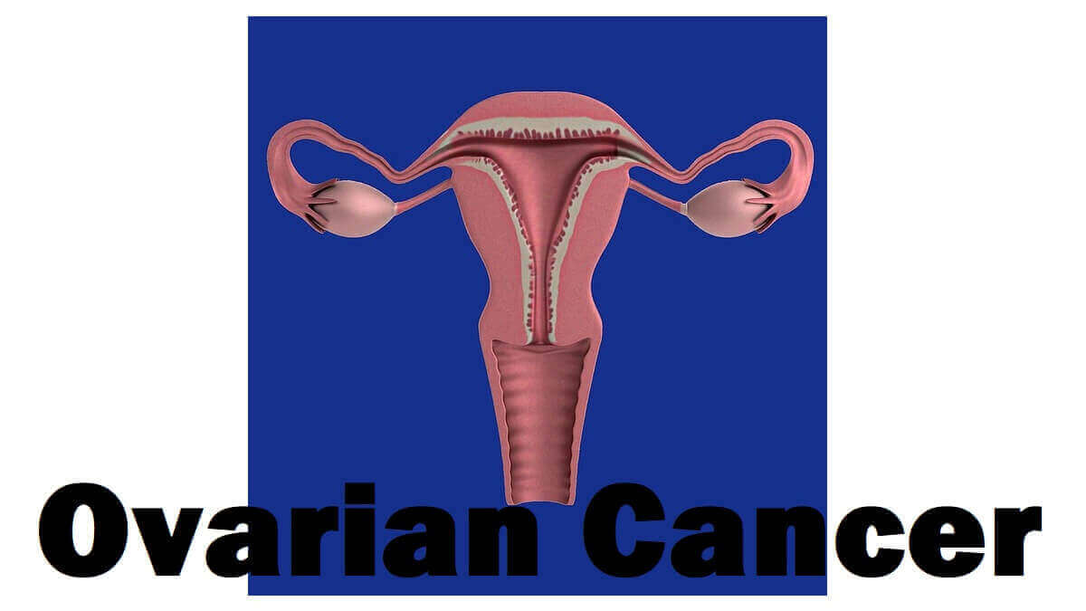 Ovarian Cancer: 3 Types, Causes, Risk Factors, Stages, Complications, and When To See a Doctor