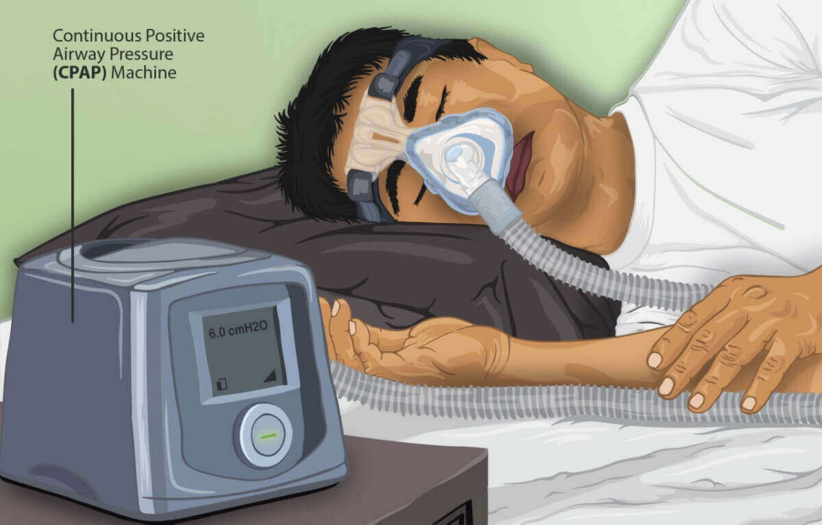 CPAP Machine Therapy 3 Parts, Benefits, How It Works, And Side Effects