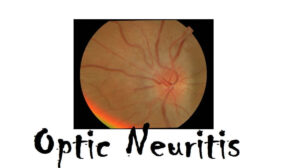 Optic Neuritis: 3 Risk Factors, Causes, Symptoms, and Diagnosis