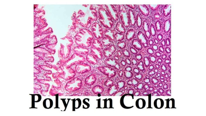 Polyps in Colon