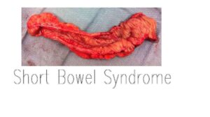 Short Bowel Syndrome: 11 Symptoms, Causes, Risk Factors, Treatment, and Prevention