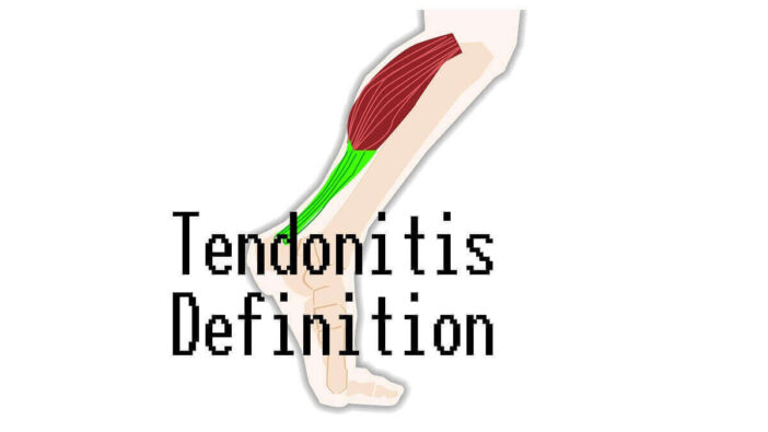Tendonitis Definition