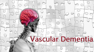 Vascular Dementia: 4 Types, Causes, Risk Factors, and Diagnosis