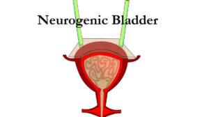 Neurogenic Bladder: Definition, Causes, 5 Risk Factors, Symptoms, Diagnostic Tests, Prevention, and Treatment