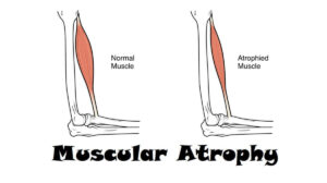 Muscular Atrophy: Definition, 3 Types, Symptoms, and Diagnosis