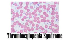 Thrombocytopenia Syndrome