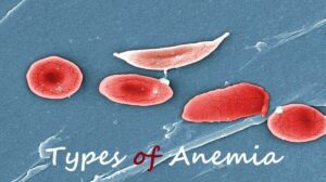 Types of Anemia