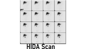 HIDA Scan: Definition, 5 Purposes, Preparation, How Does It Work, Risks and Side Effects
