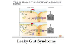 Leaky Gut Syndrome: Definition, 8 Causes, and Prevention